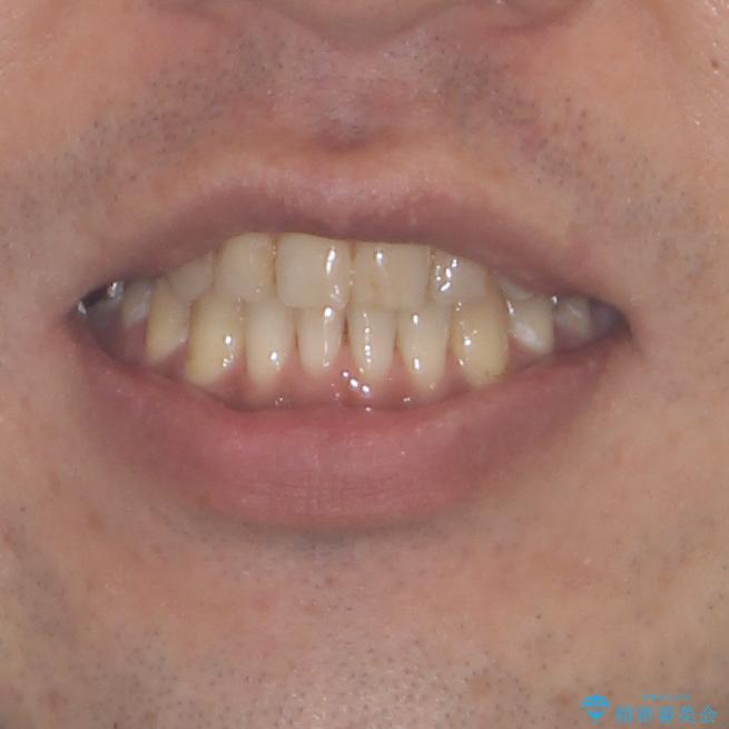 前歯の反対咬合をワイヤー矯正で改善して噛みやすくの治療後（顔貌）