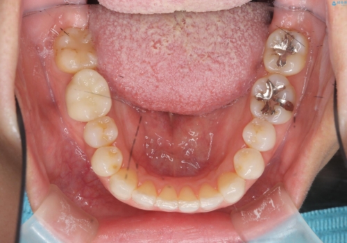 30代女性 前歯のがたつきの治療後
