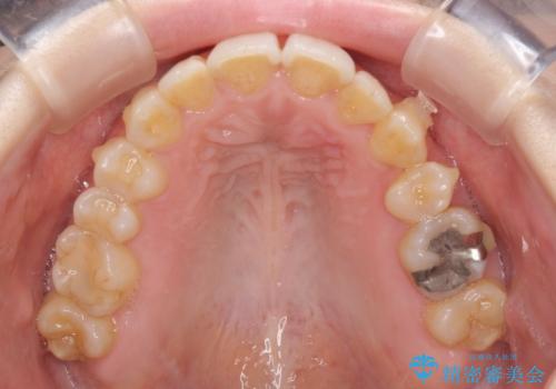 顕著な八重歯をインビザラインで治せるところまで改善の治療中