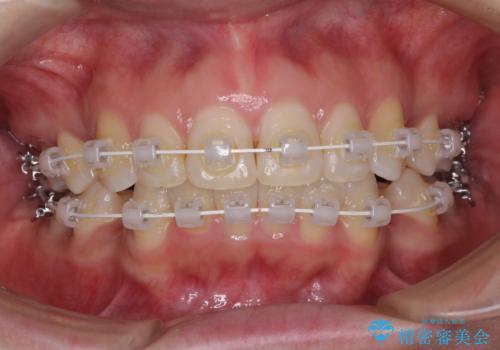 インビザラインが続けられない　ワイヤー装置による抜歯矯正の治療中