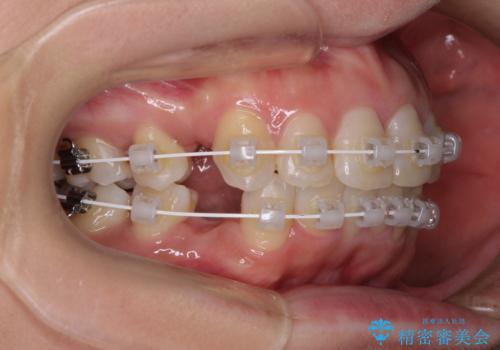 インビザラインが続けられない　ワイヤー装置による抜歯矯正の治療中