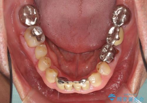 奥歯のインプラント　大人になって残っていた乳歯がダメになったの治療前
