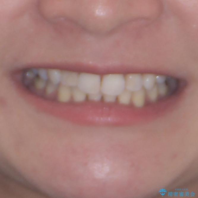 目立たないハーフリンガル矯正　抜歯矯正で口元を改善の治療後（顔貌）