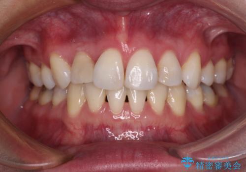 目立たないハーフリンガル矯正　抜歯矯正で口元を改善の症例 治療後
