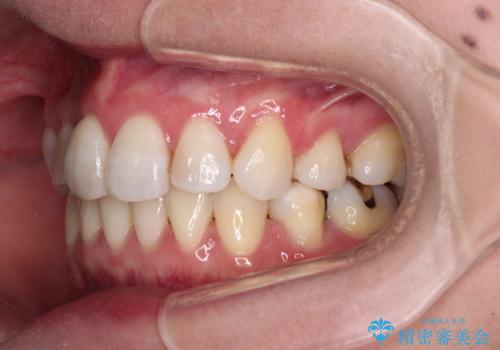 目立たないハーフリンガル矯正　抜歯矯正で口元を改善の治療後