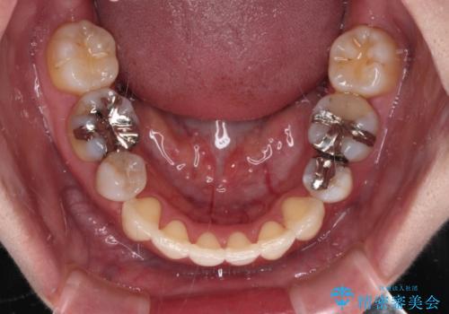 目立たないハーフリンガル矯正　抜歯矯正で口元を改善の治療後