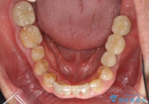 奥歯のインプラント　大人になって残っていた乳歯がダメになったの治療後