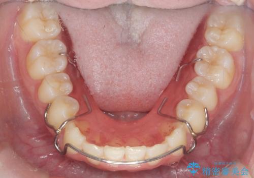 [ 前歯のガタつきを治す ]マウスピース矯正インビザラインの治療後