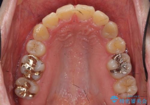 20代女性　前から5番目の歯を抜歯の治療後