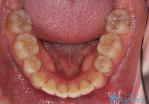 20代女性　前から5番目の歯を抜歯の治療後