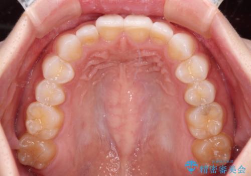 前歯の形を変えたい　前歯のラミネートベニア治療の治療後