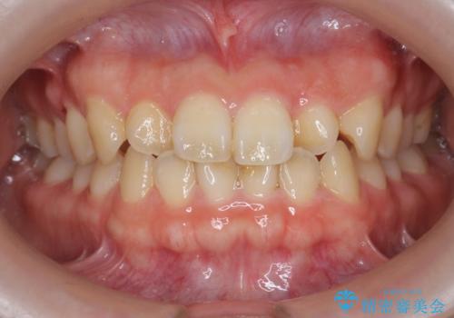 [ マウスピース矯正 ]  前歯のねじれを治したいの症例 治療前