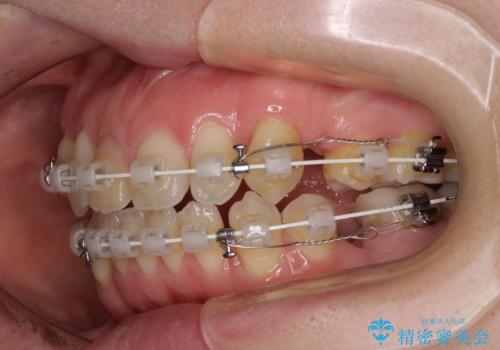 抜歯矯正で閉じにくかった口を閉じやすく改善の治療中