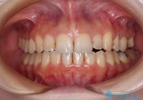 顕著な八重歯をインビザラインで治せるところまで改善の症例 治療後