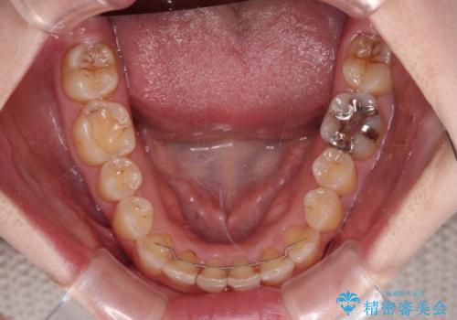 顕著な八重歯をインビザラインで治せるところまで改善の治療後