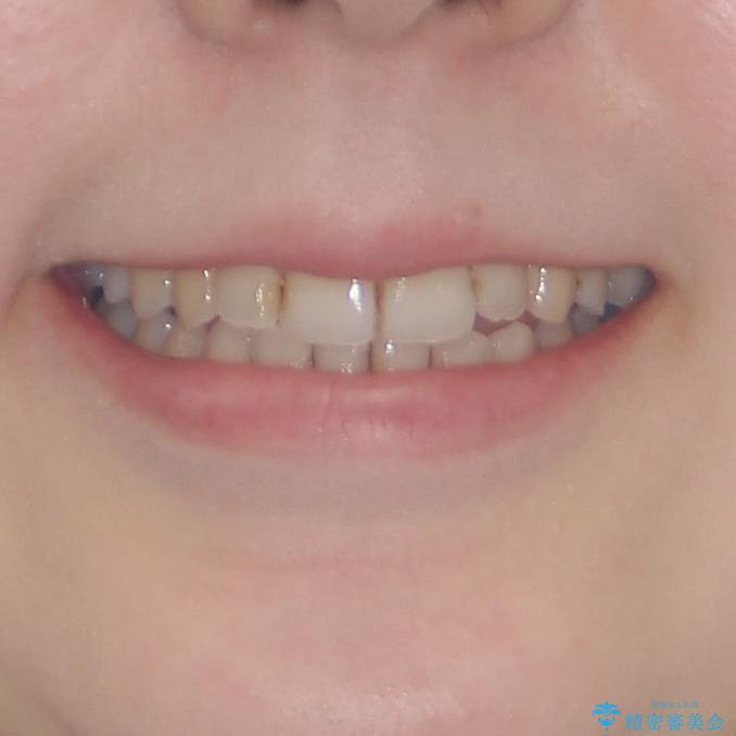顕著な八重歯をインビザラインで治せるところまで改善の治療後（顔貌）