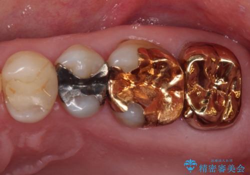 奥歯が外れた　ゴールドクラウンによる補綴治療の症例 治療後