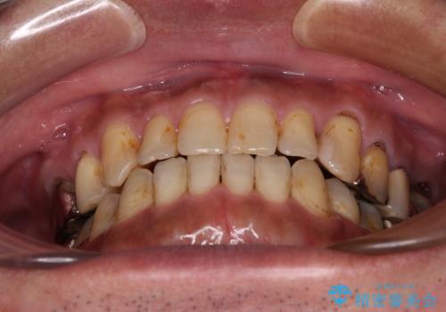 前歯の反対咬合をワイヤー矯正で改善して噛みやすくの治療後