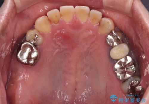前歯の反対咬合をワイヤー矯正で改善して噛みやすくの治療後