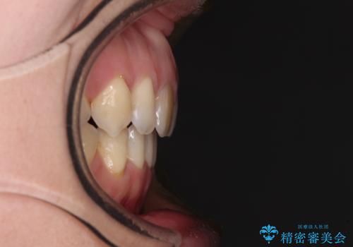 抜歯矯正で閉じにくかった口を閉じやすく改善の症例 治療後