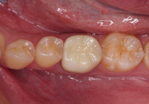 奥歯の被せものが汚れやすい　仮歯のままの歯をセラミッククラウンにの症例 治療後