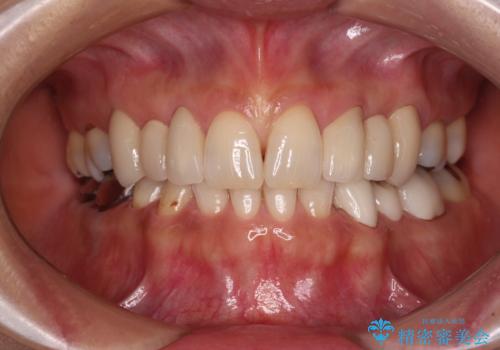 欠損の多い歯列　部分矯正とセラミックブリッジで自然な見た目にの治療後
