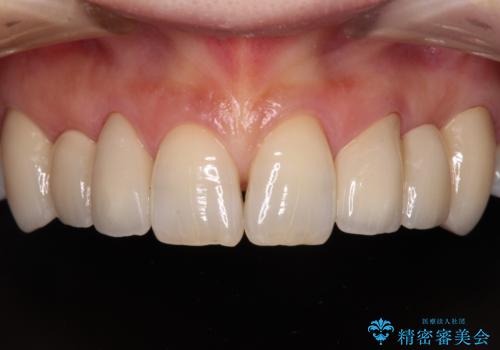 欠損の多い歯列　部分矯正とセラミックブリッジで自然な見た目にの症例 治療後