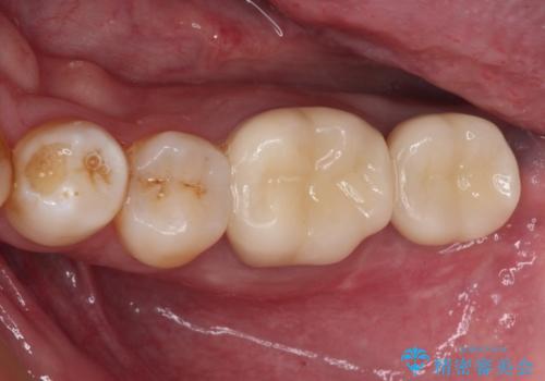 抜歯が必要な奥歯　ストローマン・インプラント補綴治療の症例 治療後