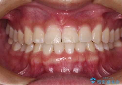隙間の空いた前歯を治したい　上顎の部分矯正の症例 治療後
