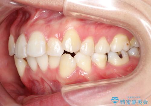目立たないハーフリンガル矯正　抜歯矯正で口元を改善の治療前