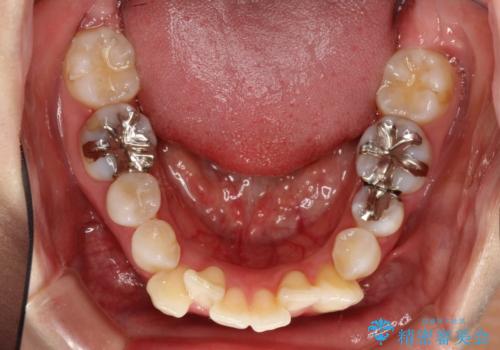 目立たないハーフリンガル矯正　抜歯矯正で口元を改善の治療前