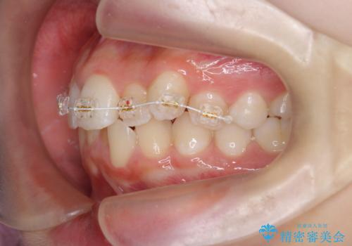 [ 前歯のガタつきを治す ]マウスピース矯正インビザラインの治療前