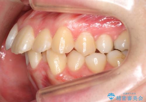 20代女性　前から5番目の歯を抜歯の治療前