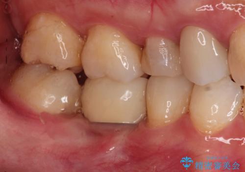 歯並びの改善とインプラントでのかみ合わせの回復　インプラント・セラミック・矯正全顎治療の治療後