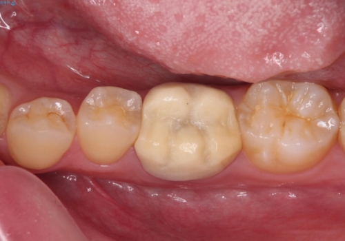 奥歯の被せものが汚れやすい　仮歯のままの歯をセラミッククラウンにの症例 治療前