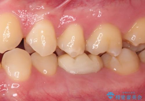 奥歯の被せものが汚れやすい　仮歯のままの歯をセラミッククラウンにの治療前