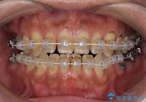 前歯の反対咬合をワイヤー矯正で改善して噛みやすくの治療中