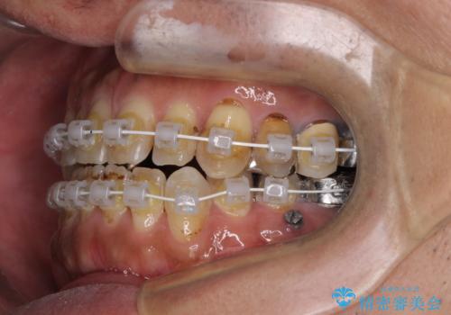 前歯の反対咬合をワイヤー矯正で改善して噛みやすくの治療中
