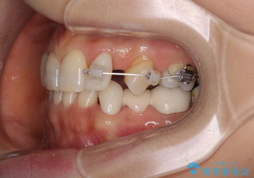 欠損の多い歯列　部分矯正とセラミックブリッジで自然な見た目にの治療中