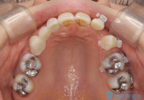 欠損の多い歯列　部分矯正とセラミックブリッジで自然な見た目にの治療中