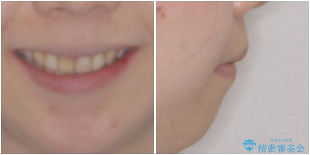 抜歯矯正で閉じにくかった口を閉じやすく改善の治療後（顔貌）