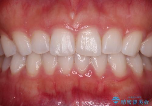 前歯の形を変えたい　前歯のラミネートベニア治療の治療前