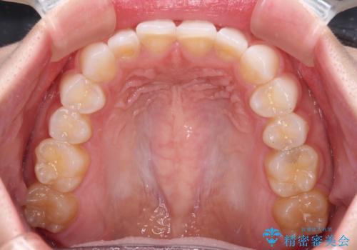 前歯の形を変えたい　前歯のラミネートベニア治療の治療前