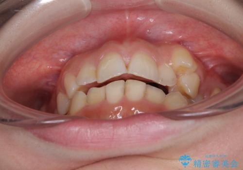 顕著な八重歯をインビザラインで治せるところまで改善の治療前