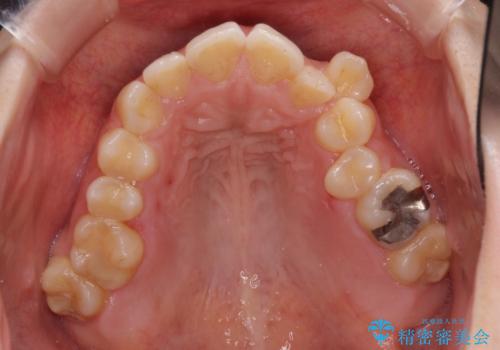 顕著な八重歯をインビザラインで治せるところまで改善の治療前