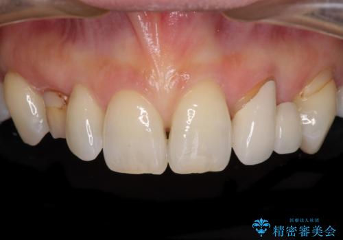 欠損の多い歯列　部分矯正とセラミックブリッジで自然な見た目にの症例 治療前