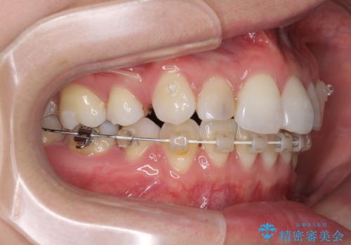 目立たないハーフリンガル矯正　抜歯矯正で口元を改善の治療中