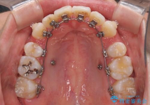 目立たないハーフリンガル矯正　抜歯矯正で口元を改善の治療中