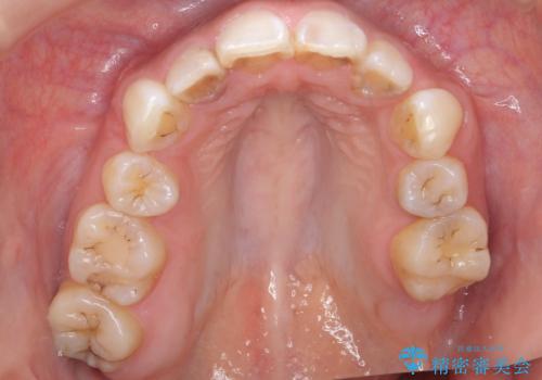フロスを通すと臭い　歯と歯の間の虫歯　セラミックインレー　30代女性の治療前