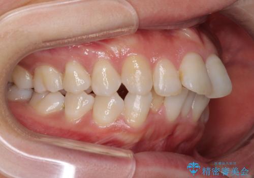 インビザラインが続けられない　ワイヤー装置による抜歯矯正の治療前